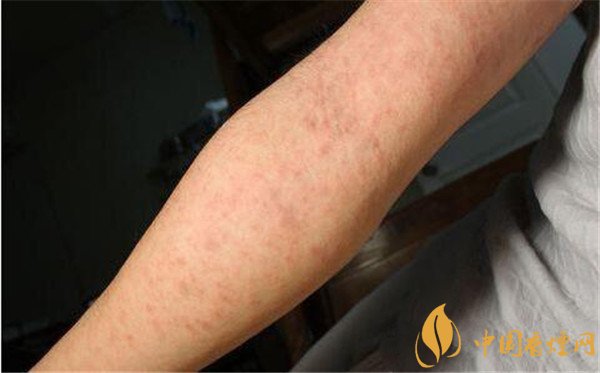 戒煙藥暢沛副作用有哪些 戒煙藥暢沛對(duì)人體的危害(有自殺風(fēng)險(xiǎn))